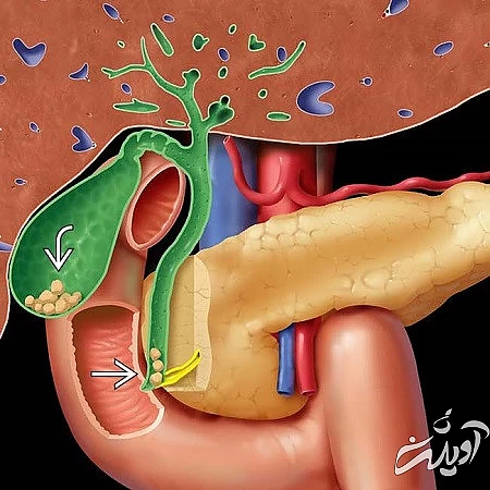 روش پیشگیری از ابتلا به لجن صفراوی پیروی سنگ های صفراوی, لجن صفرا, پاکسازی لجن صفرا